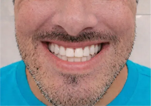 Full Arch Implants before treatment — full arch implant service — MAP Dental Center Houston