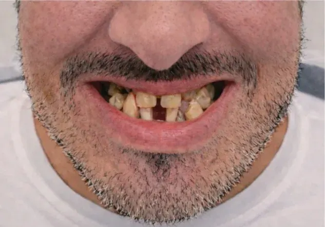 Full Arch Implants after treatment — full arch implant service — MAP Dental Center Houston