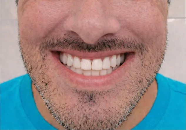 Full-arch implant patient after treatment