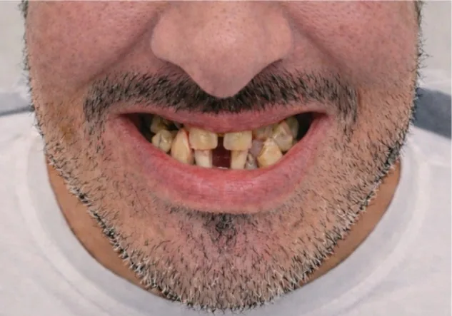 Full-arch implant patient before treatment