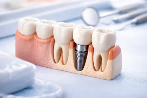 Dental implants