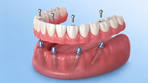 Full-arch implants