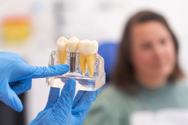 Dental implants recovery restoration