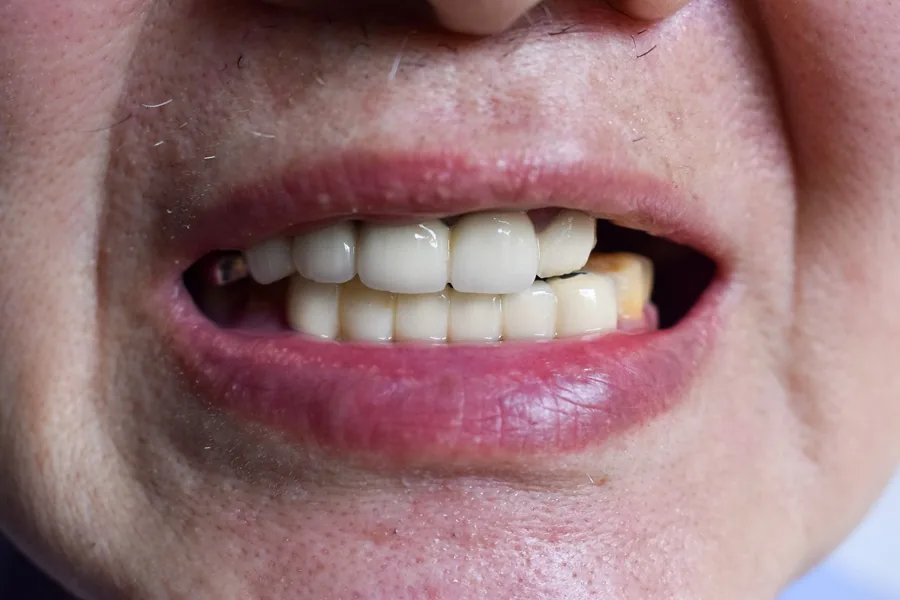 Full arch patient 1 before