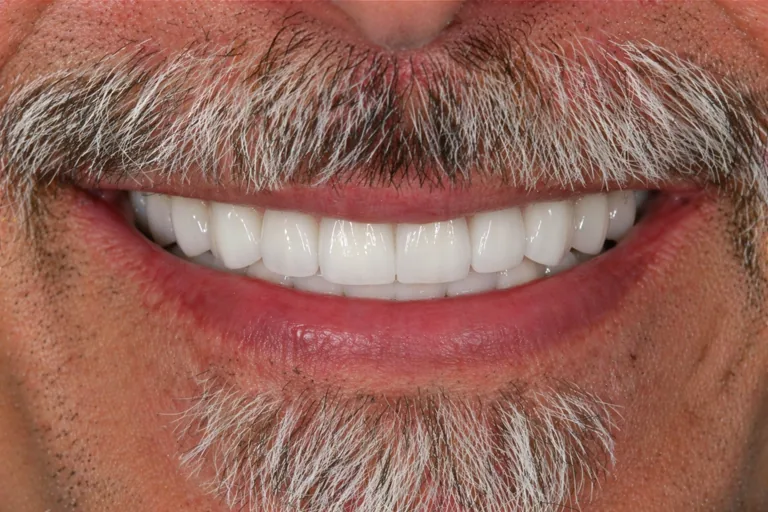 Full arch patient 2 after