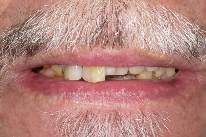 Full arch patient 2 before