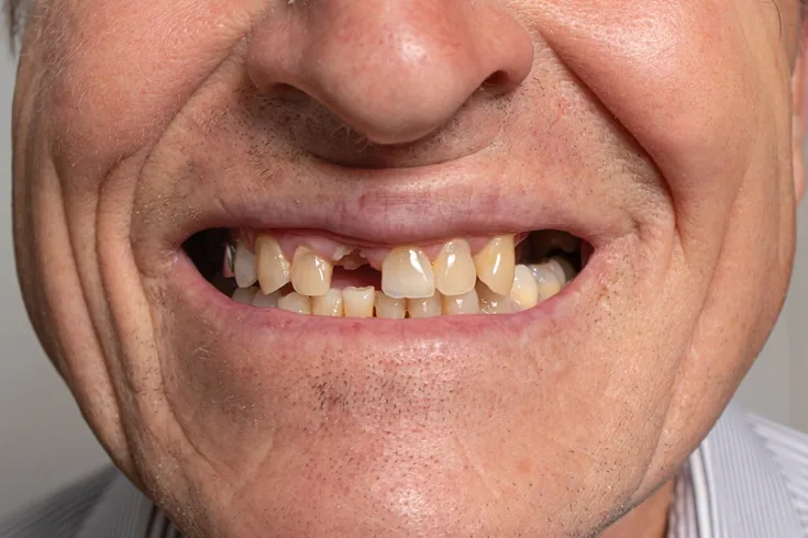 Full arch patient 3 before