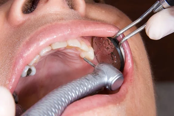 Close-up of full-mouth rehabilitation treatment in progress