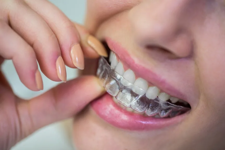 Ortho clear aligner