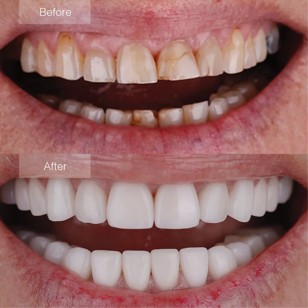 Porcelain veneers before and after smile transformation