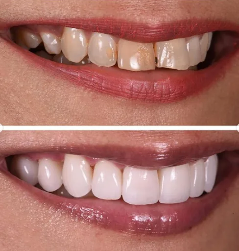 Veneers smile transformation before and after